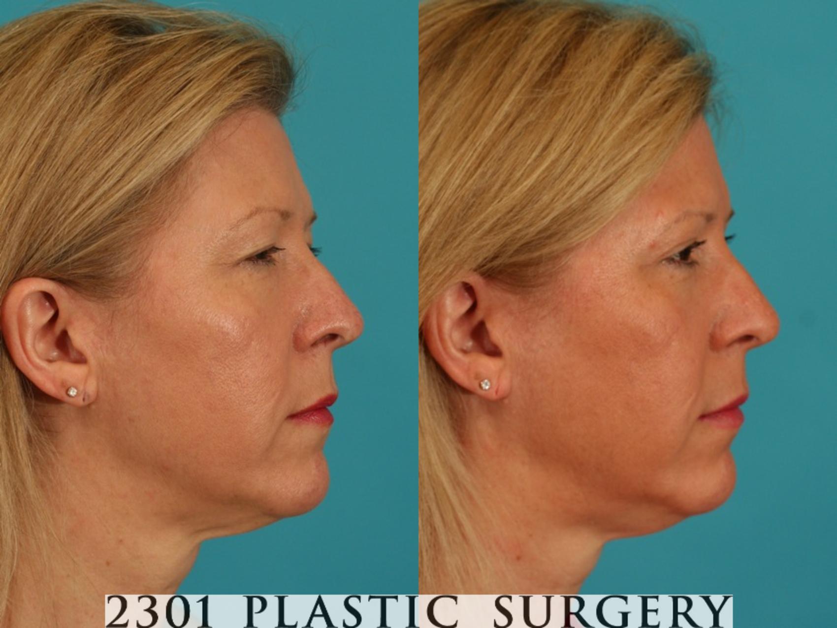 Before & After Blepharoplasty Case 67 View #2 View in Fort Worth & Frisco, Texas