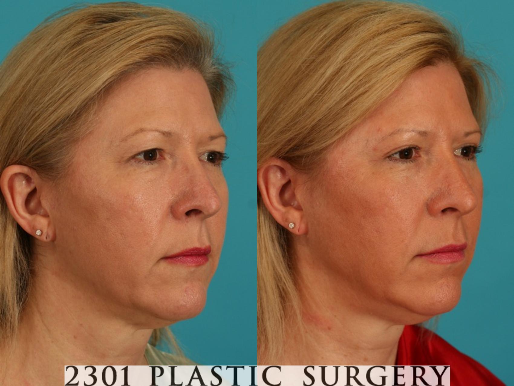 Before & After Blepharoplasty Case 67 View #3 View in Fort Worth & Frisco, Texas