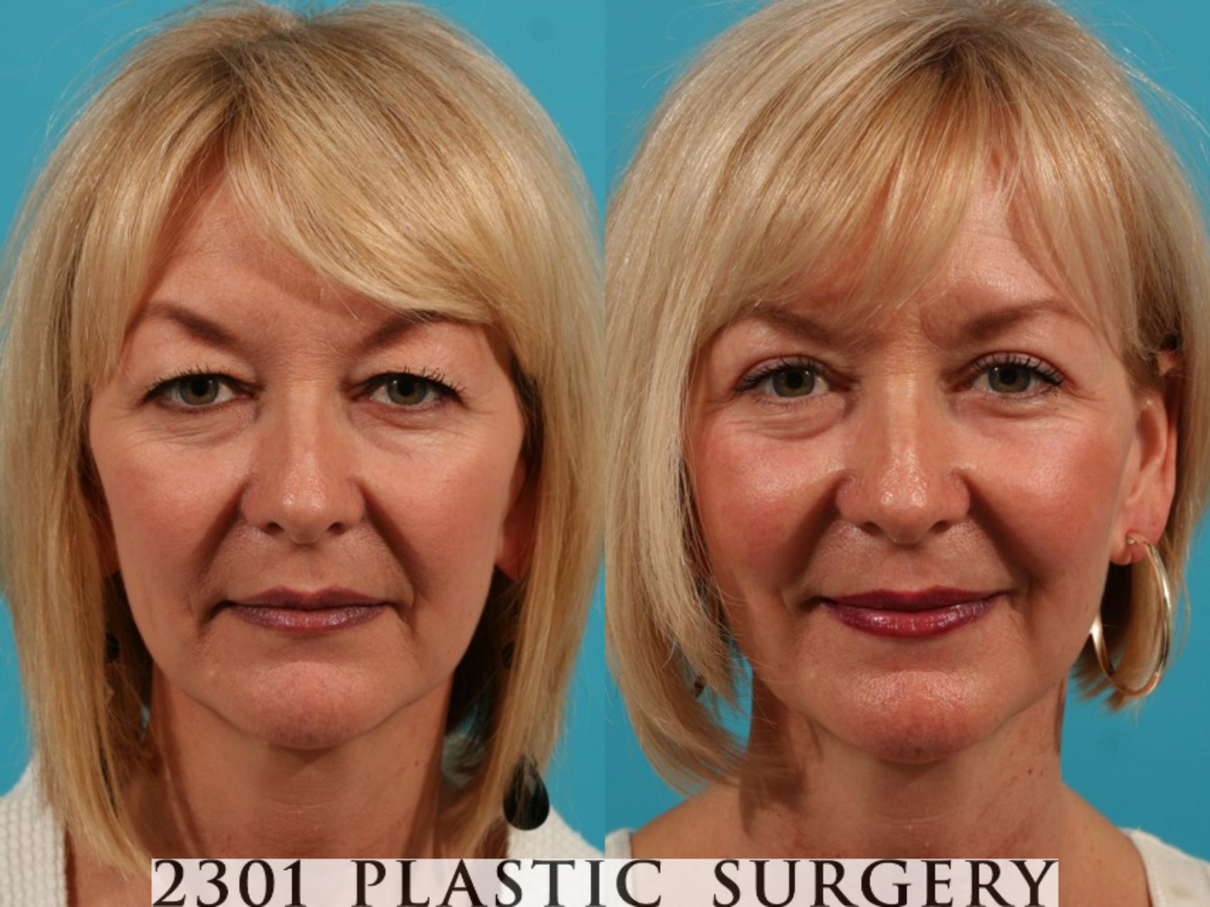 Before & After Blepharoplasty Case 70 View #1 View in Fort Worth & Frisco, Texas