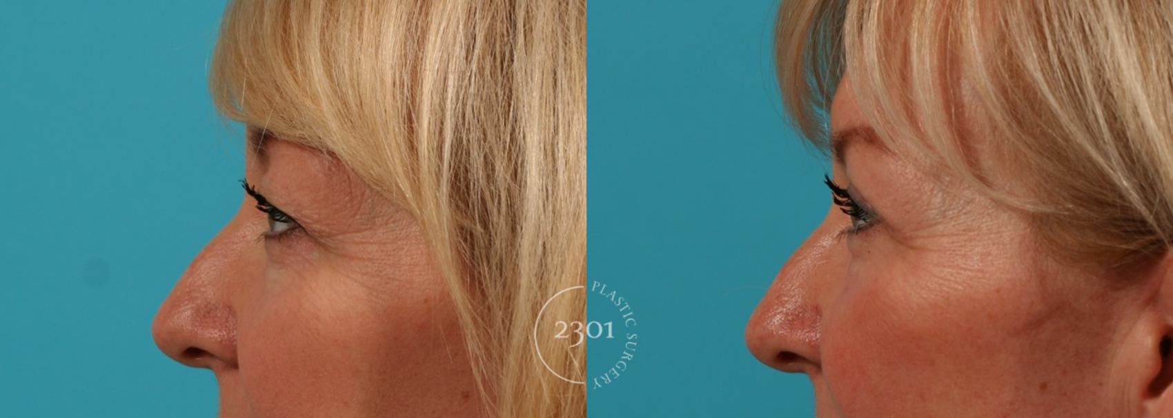 Before & After Blepharoplasty Case 70 View #2 View in Fort Worth, Plano, & Frisco, Texas