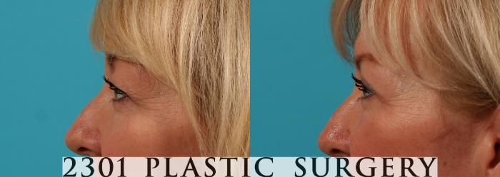Before & After Blepharoplasty Case 70 View #2 View in Fort Worth, Plano, & Frisco, Texas