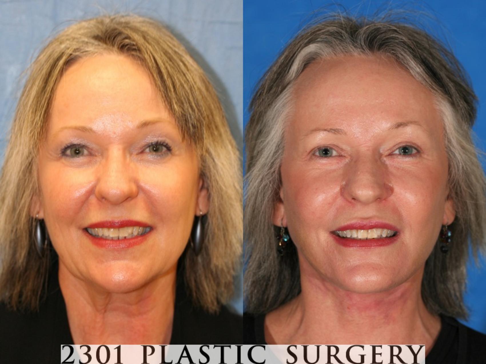 Before & After Neck Lift Case 71 View #1 View in Fort Worth, Plano, & Frisco, Texas