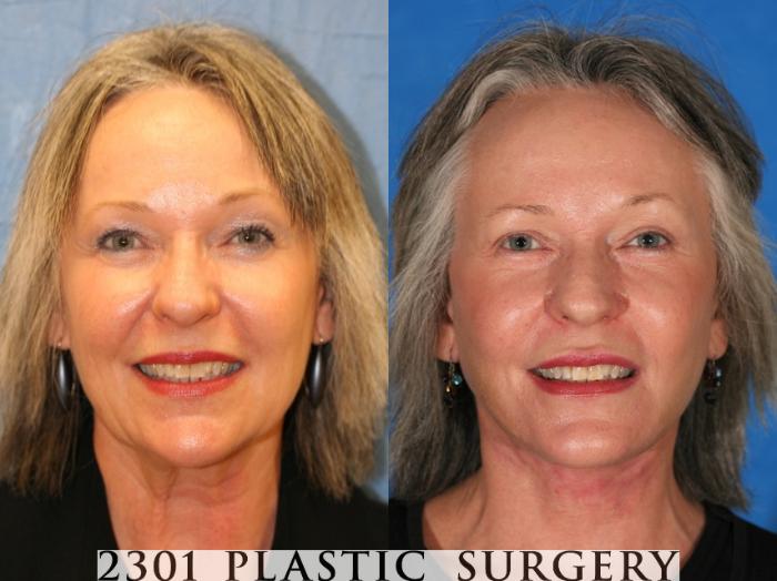 Before & After Skin Resurfacing Case 71 View #1 View in Fort Worth & Frisco, Texas