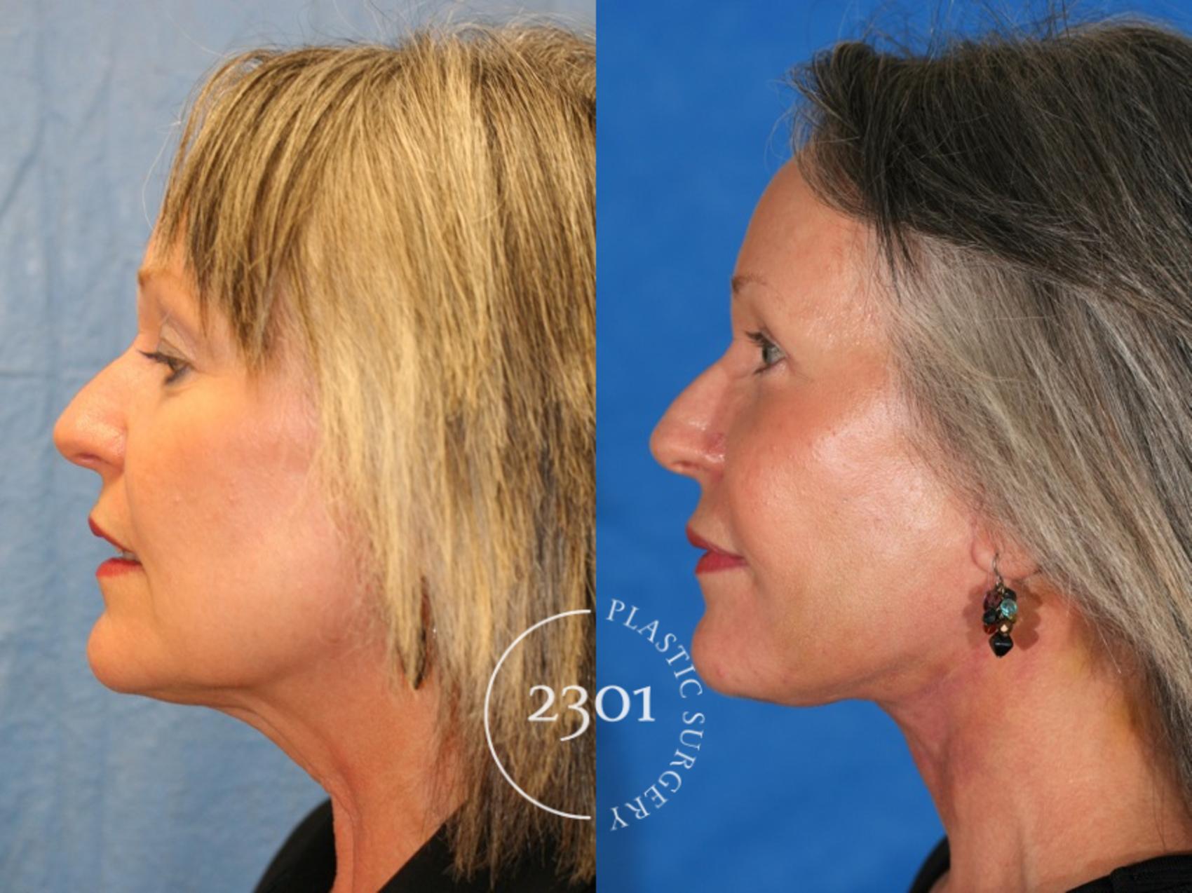 Before & After Blepharoplasty Case 71 View #2 View in Fort Worth, Plano, & Frisco, Texas