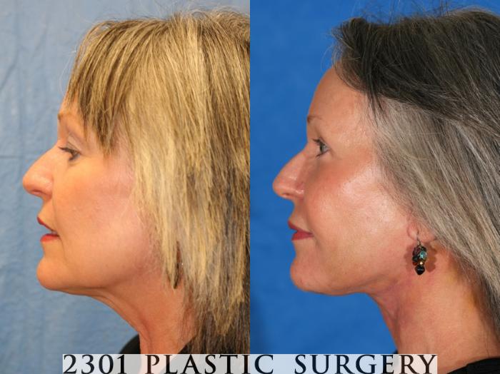 Before & After Face Lift Case 71 View #2 View in Fort Worth, Plano, & Frisco, Texas