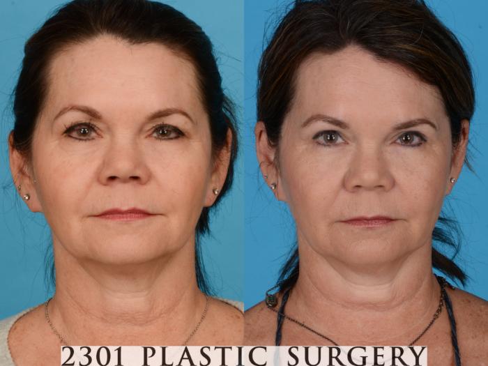 Before & After Blepharoplasty Case 734 Front View in Fort Worth, Plano, & Frisco, Texas
