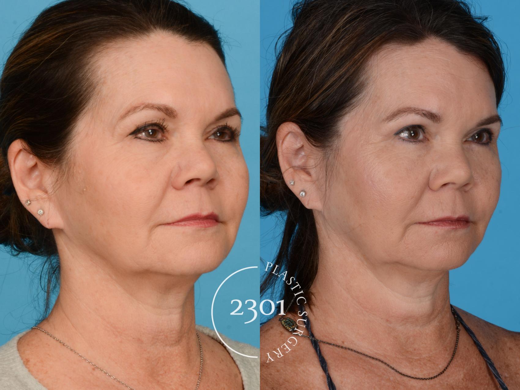 Before & After Eyelid Surgery (Upper) Case 734 Right Oblique View in Fort Worth, Plano, & Frisco, Texas