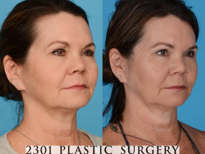 Before & After Blepharoplasty Case 734 Right Oblique View in Fort Worth, Plano, & Frisco, Texas