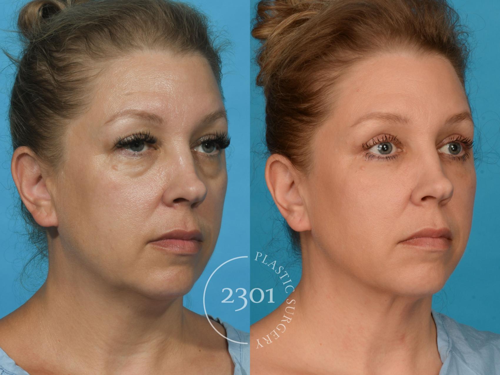 Before & After Blepharoplasty Case 739 Right Oblique View in Fort Worth, Plano, & Frisco, Texas