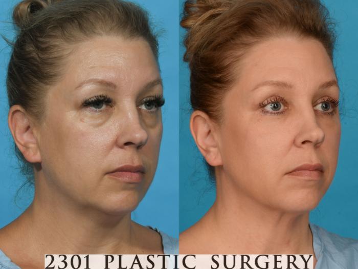 Before & After Blepharoplasty Case 739 Right Oblique View in Fort Worth, Plano, & Frisco, Texas