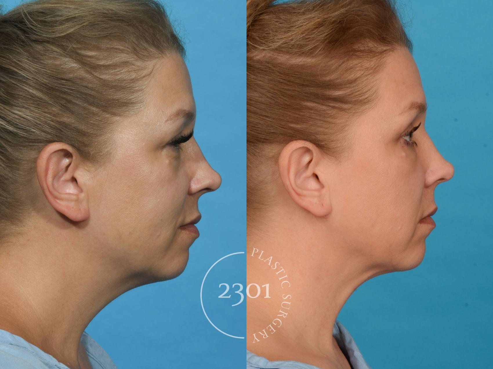 Before & After Blepharoplasty Case 739 Right Side View in Fort Worth, Plano, & Frisco, Texas