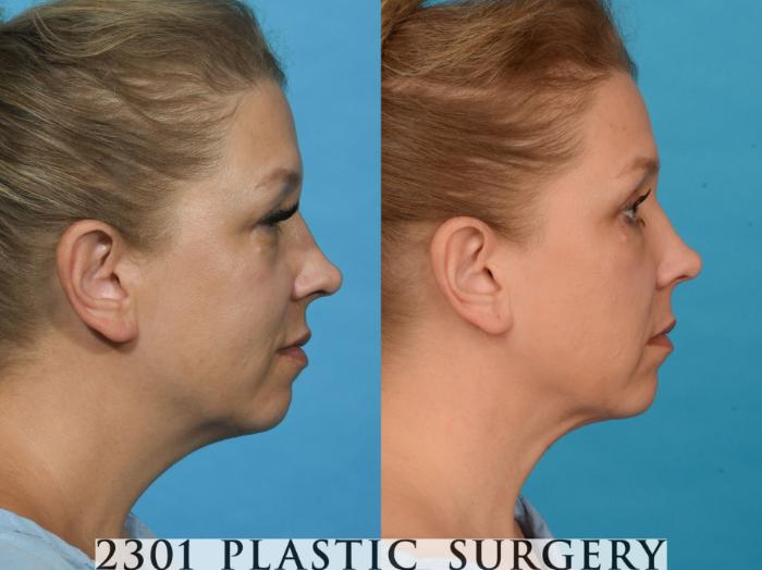 Before & After Blepharoplasty Case 739 Right Side View in Fort Worth, Plano, & Frisco, Texas
