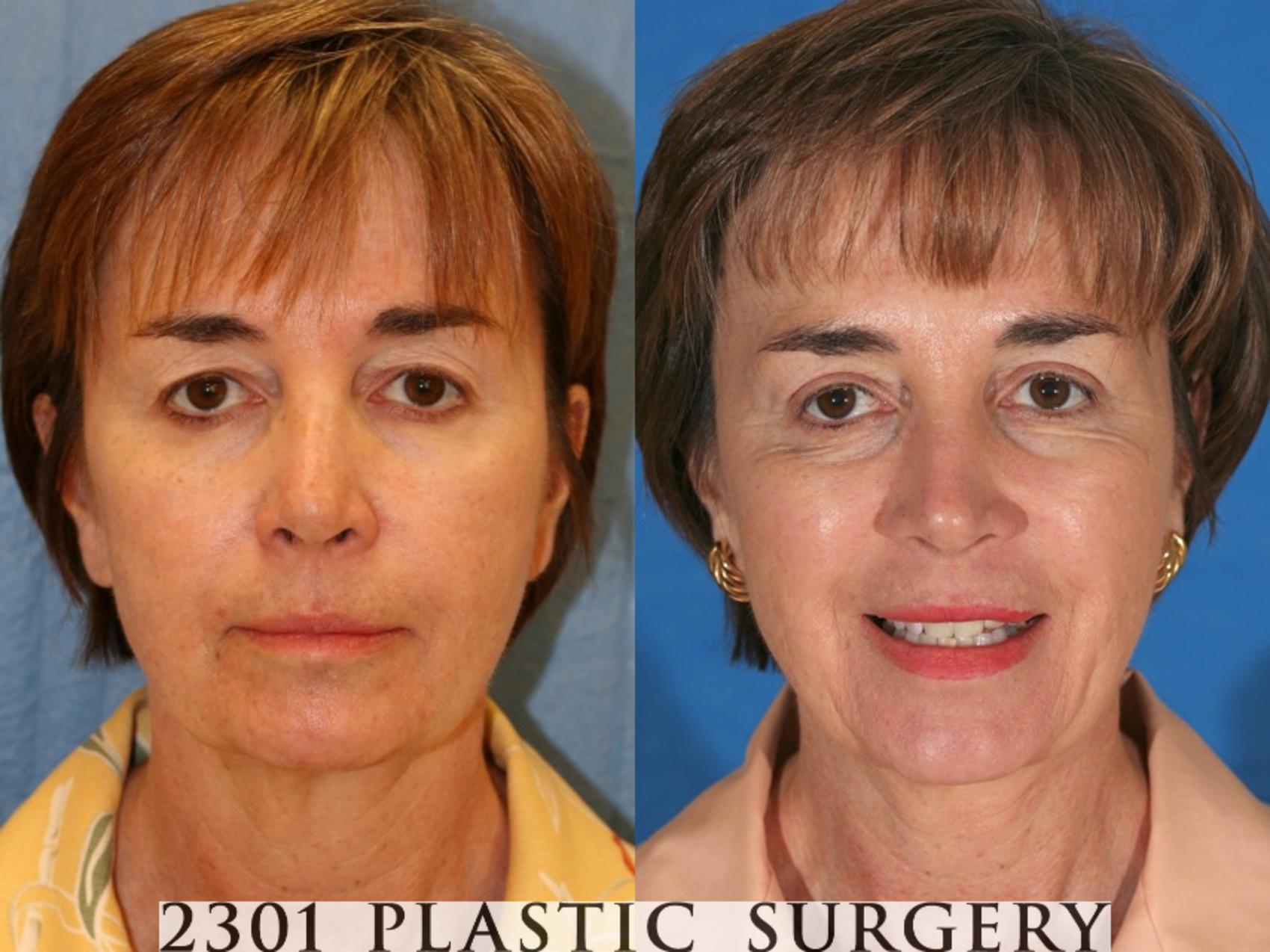 Before & After Blepharoplasty Case 74 View #1 View in Fort Worth, Plano, & Frisco, Texas