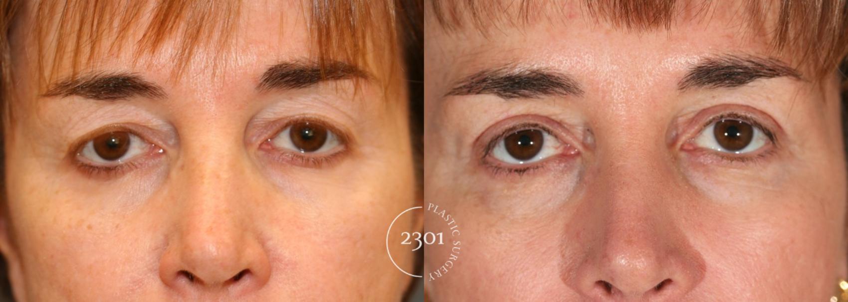 Before & After Blepharoplasty Case 74 View #2 View in Fort Worth, Plano, & Frisco, Texas