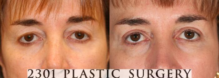 Before & After Blepharoplasty Case 74 View #2 View in Fort Worth, Plano, & Frisco, Texas