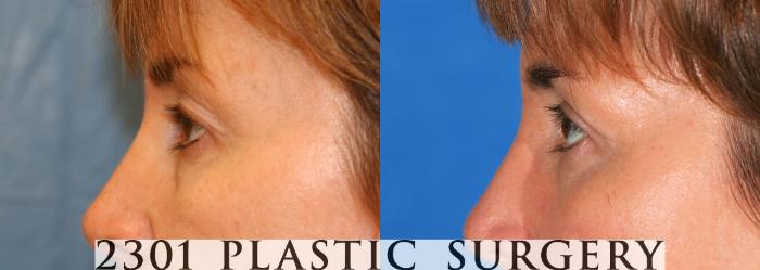 Before & After Blepharoplasty Case 74 View #3 View in Fort Worth, Plano, & Frisco, Texas