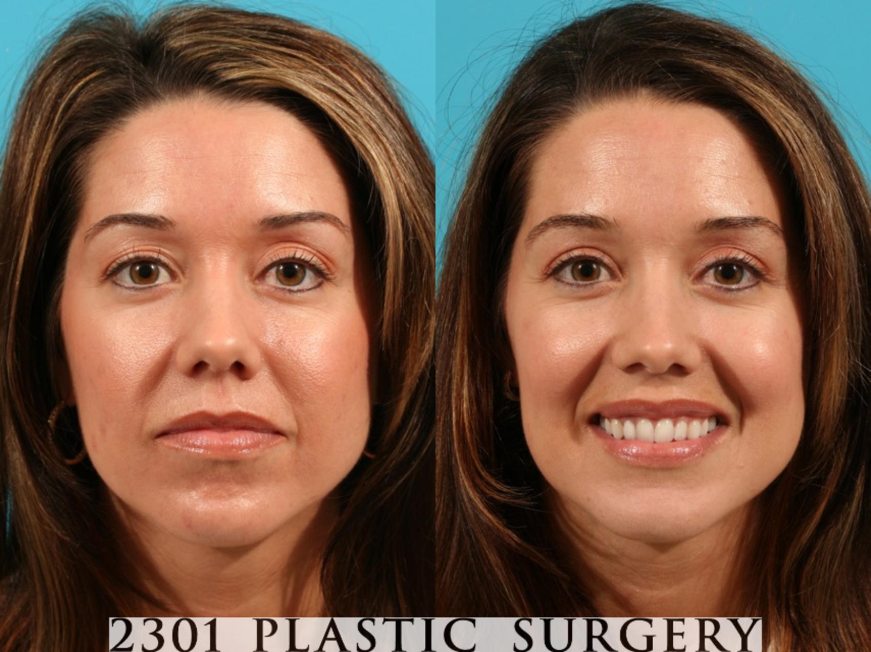 Before & After Blepharoplasty Case 76 View #1 View in Fort Worth & Frisco, Texas