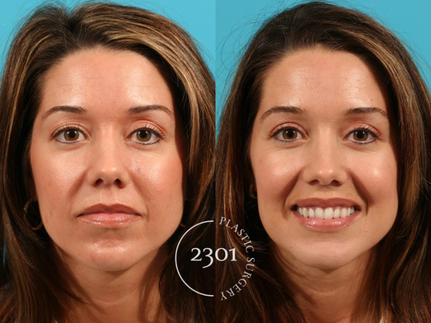 Before & After Blepharoplasty Case 76 View #1 View in Fort Worth, Plano, & Frisco, Texas