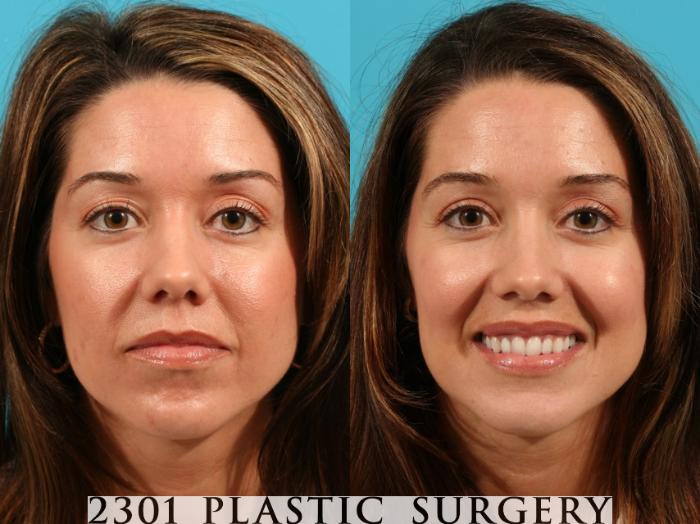 Before & After Blepharoplasty Case 76 View #1 View in Fort Worth, Plano, & Frisco, Texas