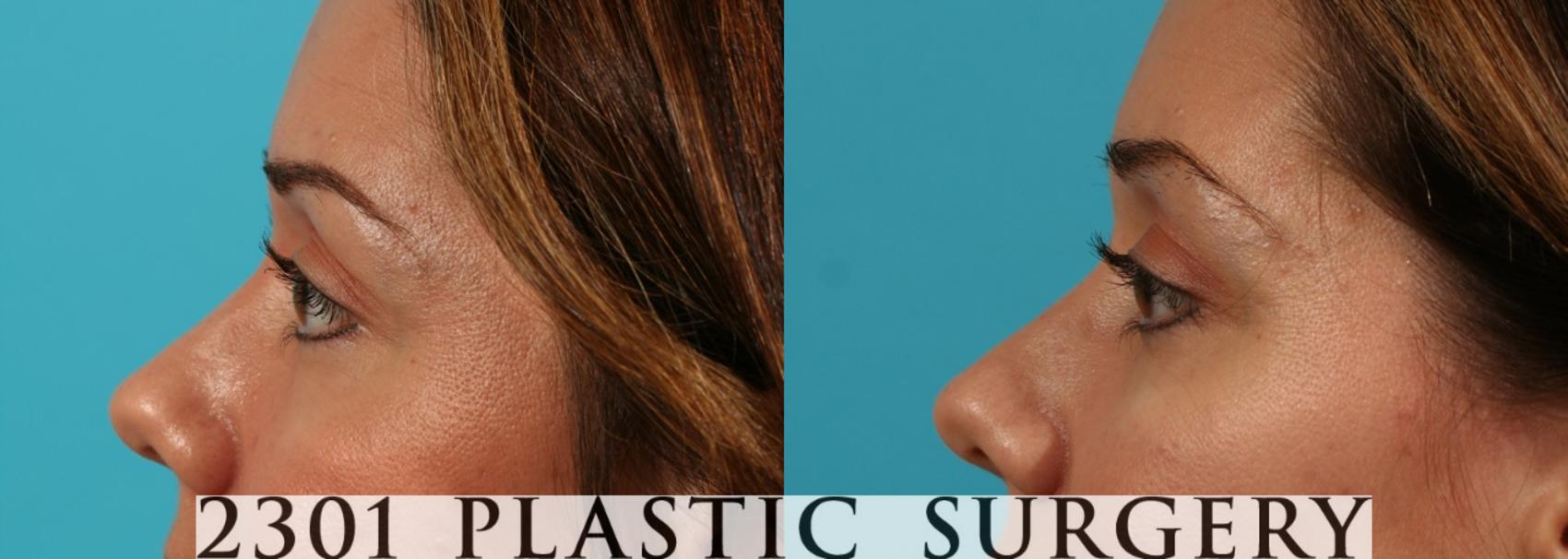Before & After Blepharoplasty Case 76 View #2 View in Fort Worth & Frisco, Texas
