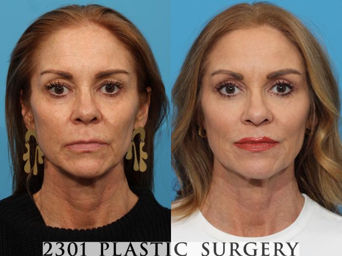 Before & After Blepharoplasty Case 768 Front View in Fort Worth, Plano, & Frisco, Texas