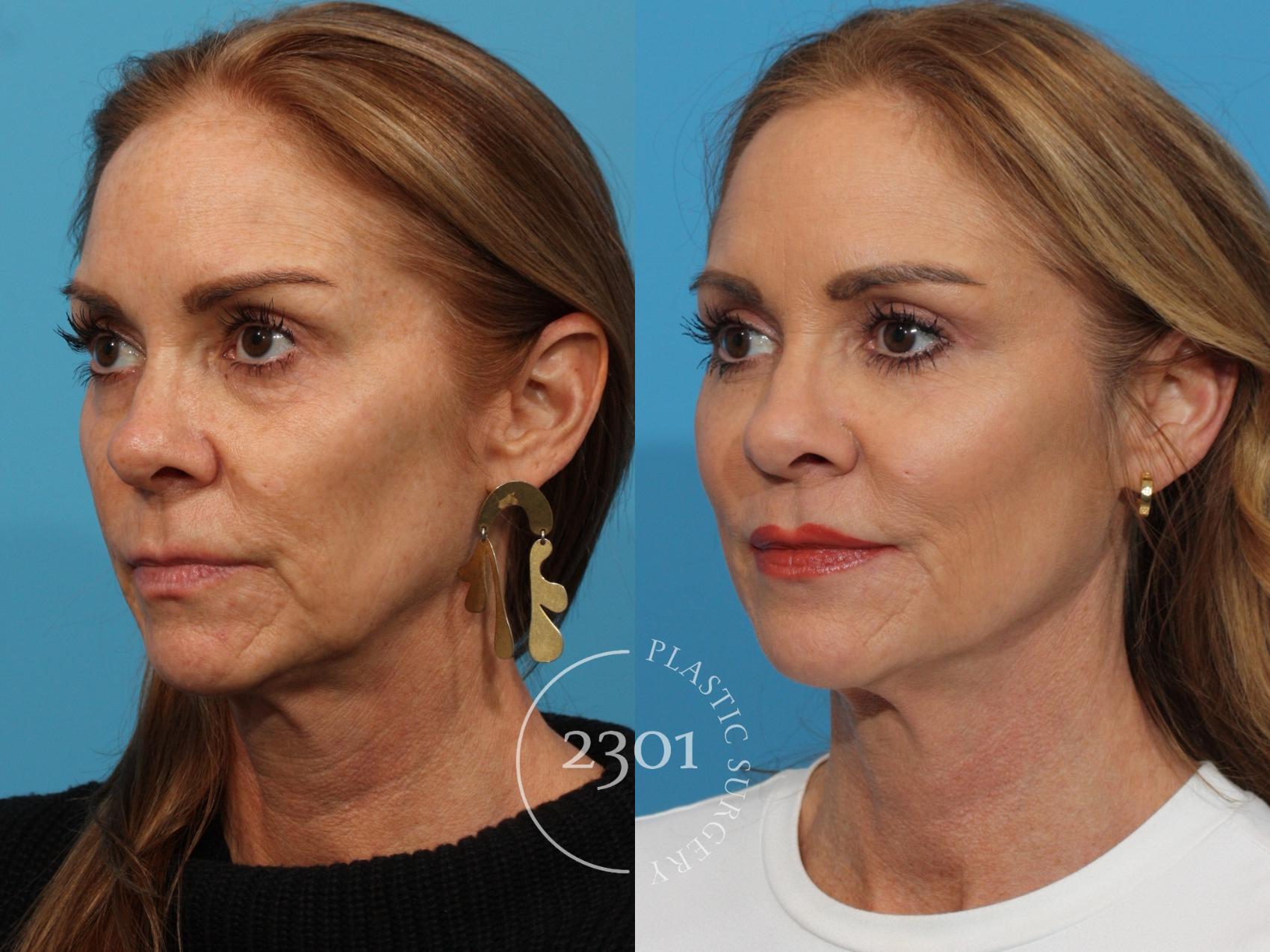 Before & After Facial Fat Grafting Case 768 Left Oblique View in Fort Worth, Plano, & Frisco, Texas