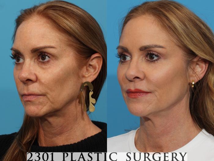 Before & After Blepharoplasty Case 768 Left Oblique View in Fort Worth, Plano, & Frisco, Texas