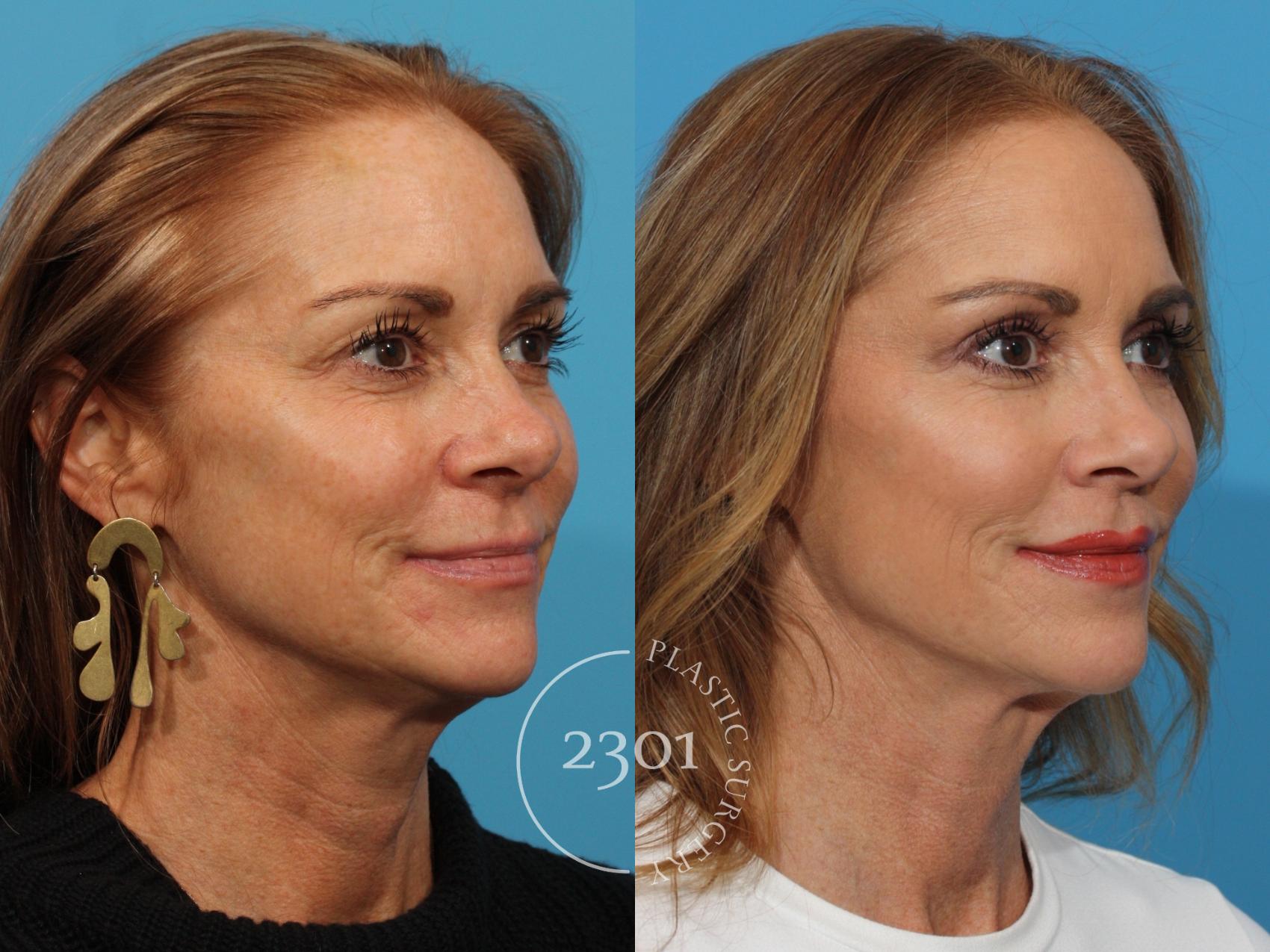 Before & After Facial Fat Grafting Case 768 Right Oblique View in Fort Worth, Plano, & Frisco, Texas