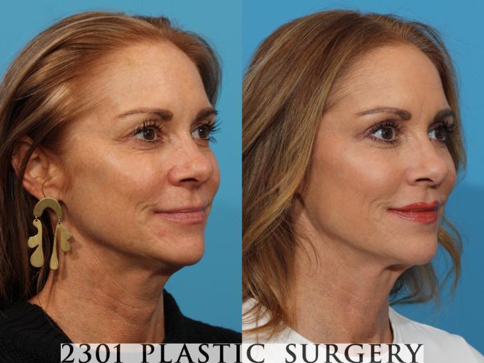 Before & After Blepharoplasty Case 768 Right Oblique View in Fort Worth, Plano, & Frisco, Texas