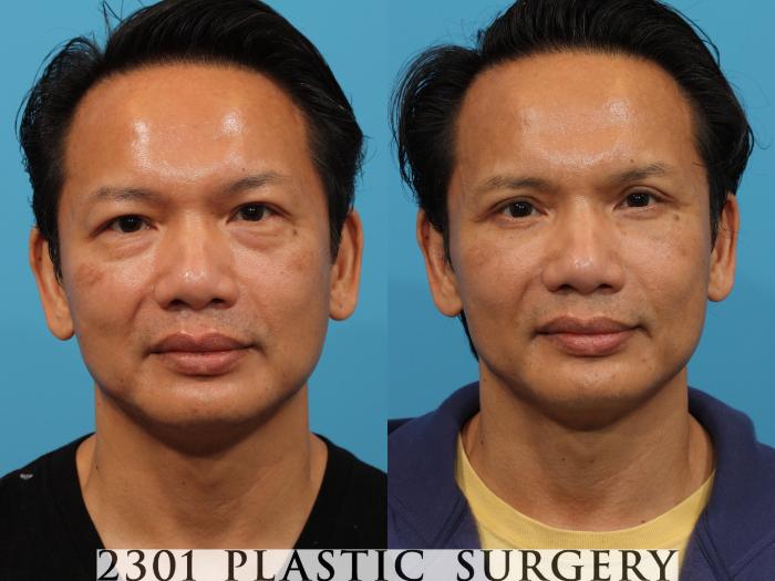 Before & After Blepharoplasty Case 771 Front View in Fort Worth, Plano, & Frisco, Texas