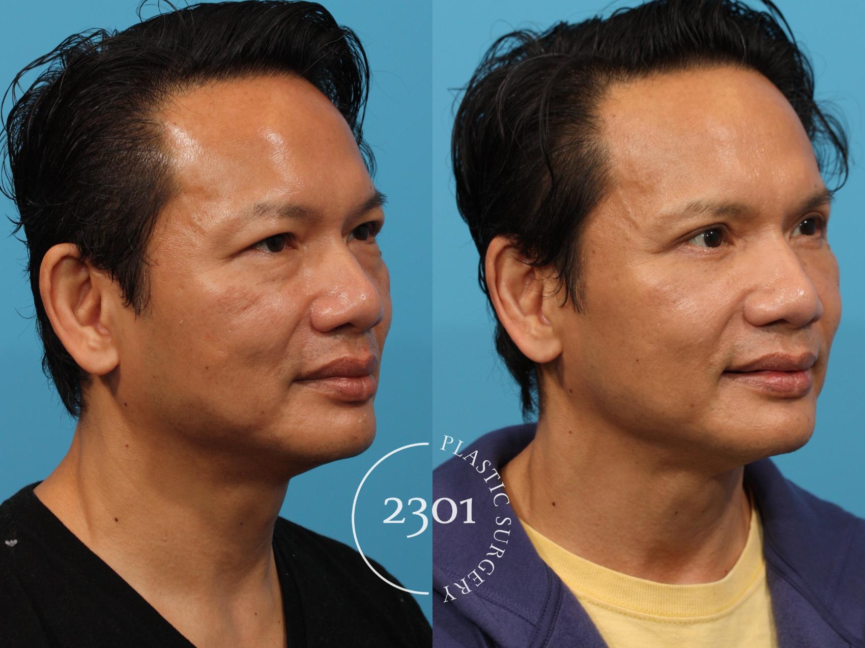 Before & After Blepharoplasty Case 771 Right Oblique View in Fort Worth, Plano, & Frisco, Texas