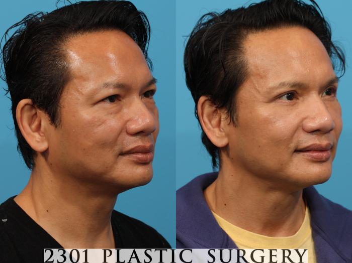 Before & After Blepharoplasty Case 771 Right Oblique View in Fort Worth, Plano, & Frisco, Texas