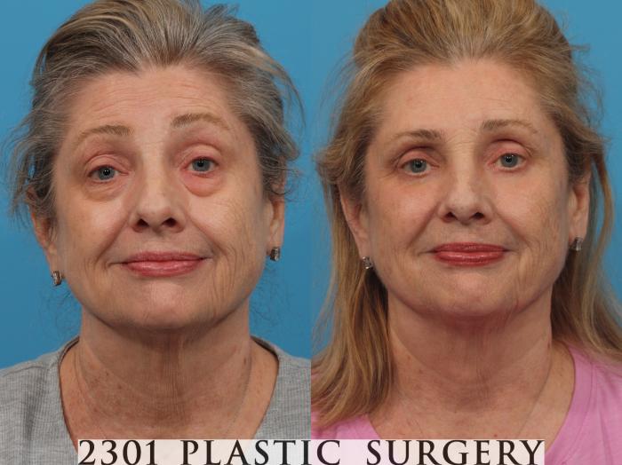Before & After Blepharoplasty Case 789 Front View in Fort Worth, Plano, & Frisco, Texas