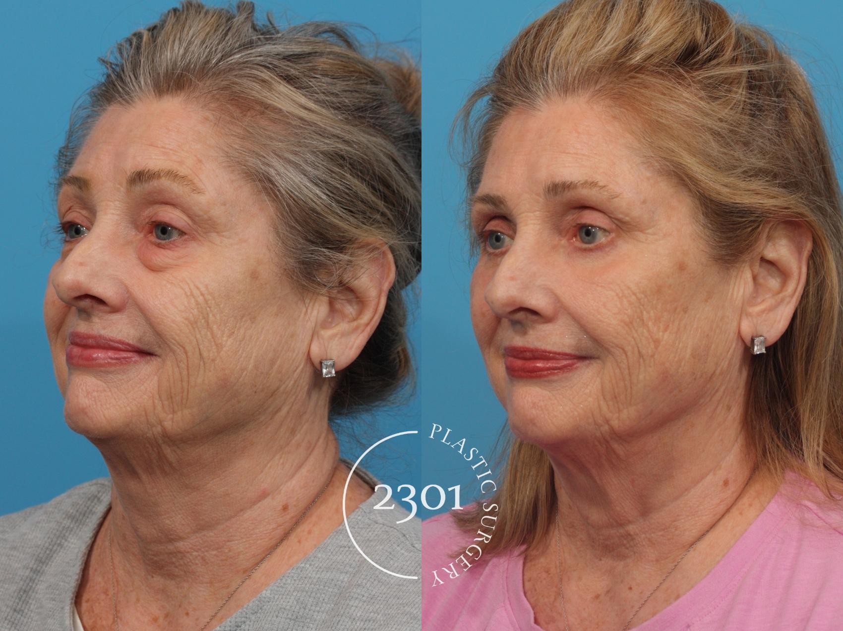 Before & After Facial Fat Grafting Case 789 Left Oblique View in Fort Worth, Plano, & Frisco, Texas