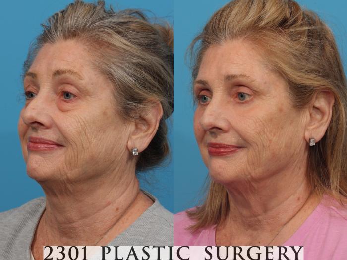 Before & After Blepharoplasty Case 789 Left Oblique View in Fort Worth, Plano, & Frisco, Texas