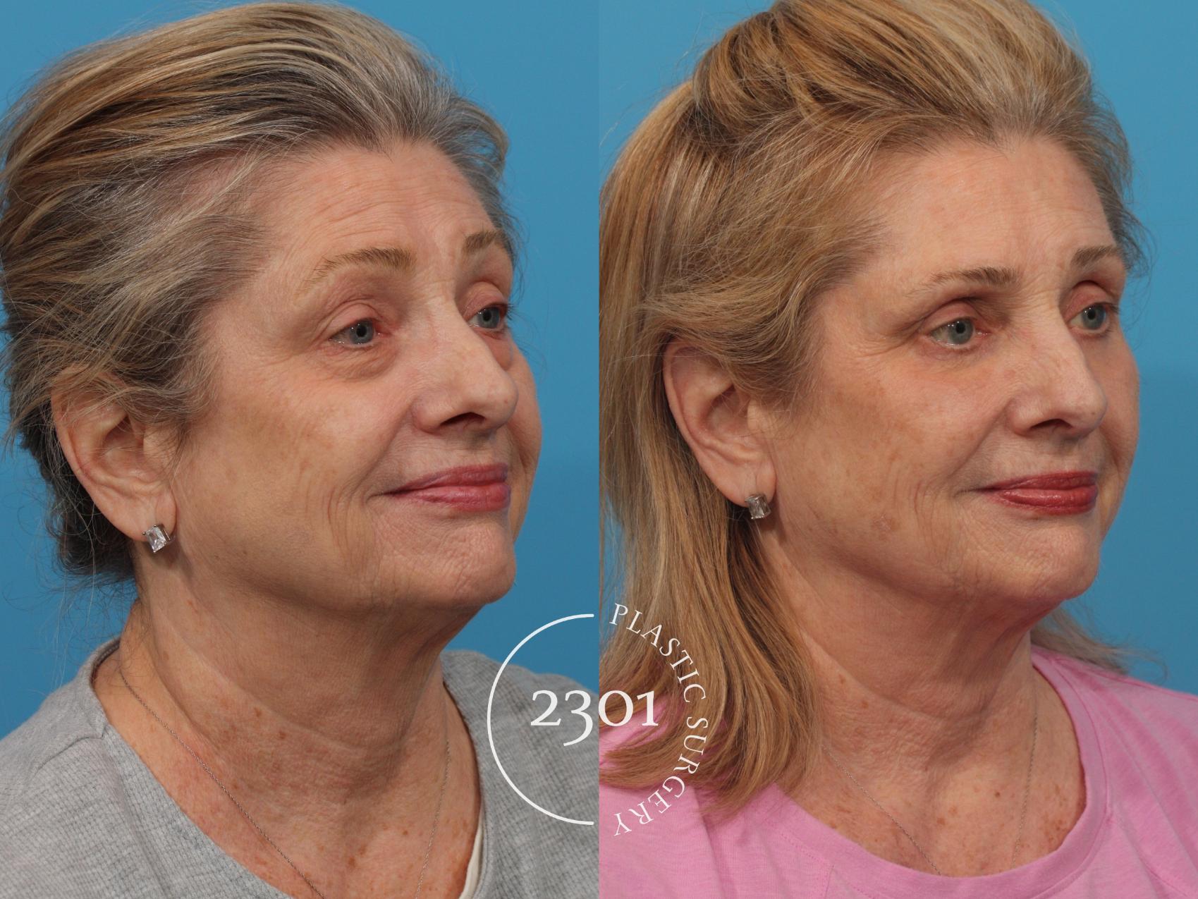 Before & After Facial Fat Grafting Case 789 Right Oblique View in Fort Worth, Plano, & Frisco, Texas