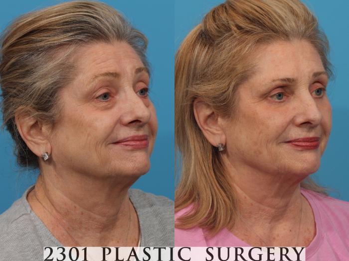 Before & After Blepharoplasty Case 789 Right Oblique View in Fort Worth, Plano, & Frisco, Texas