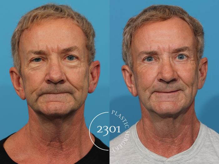 Before & After Blepharoplasty Case 820 Front View in Fort Worth, Plano, & Frisco, Texas