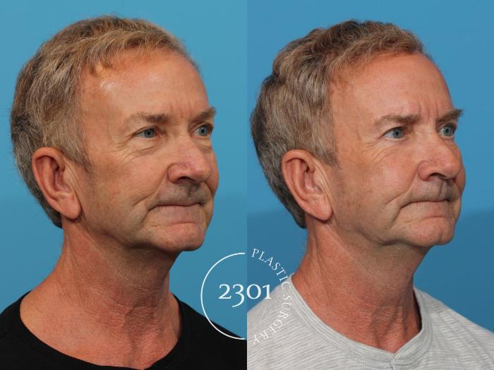 Before & After Blepharoplasty Case 820 Right Oblique View in Fort Worth, Plano, & Frisco, Texas