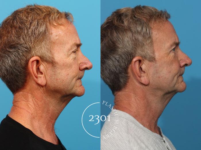 Before & After Blepharoplasty Case 820 Right Side View in Fort Worth, Plano, & Frisco, Texas