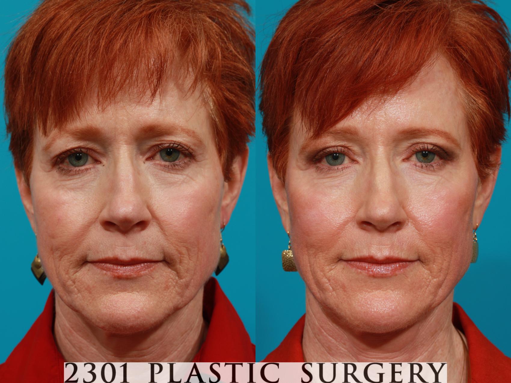 Before & After Blepharoplasty Case 84 View #1 View in Fort Worth & Frisco, Texas
