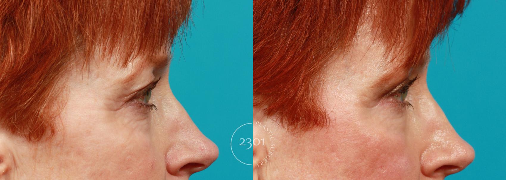 Before & After Blepharoplasty Case 84 View #2 View in Fort Worth, Plano, & Frisco, Texas