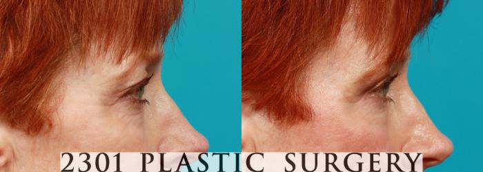 Before & After Blepharoplasty Case 84 View #2 View in Fort Worth, Plano, & Frisco, Texas