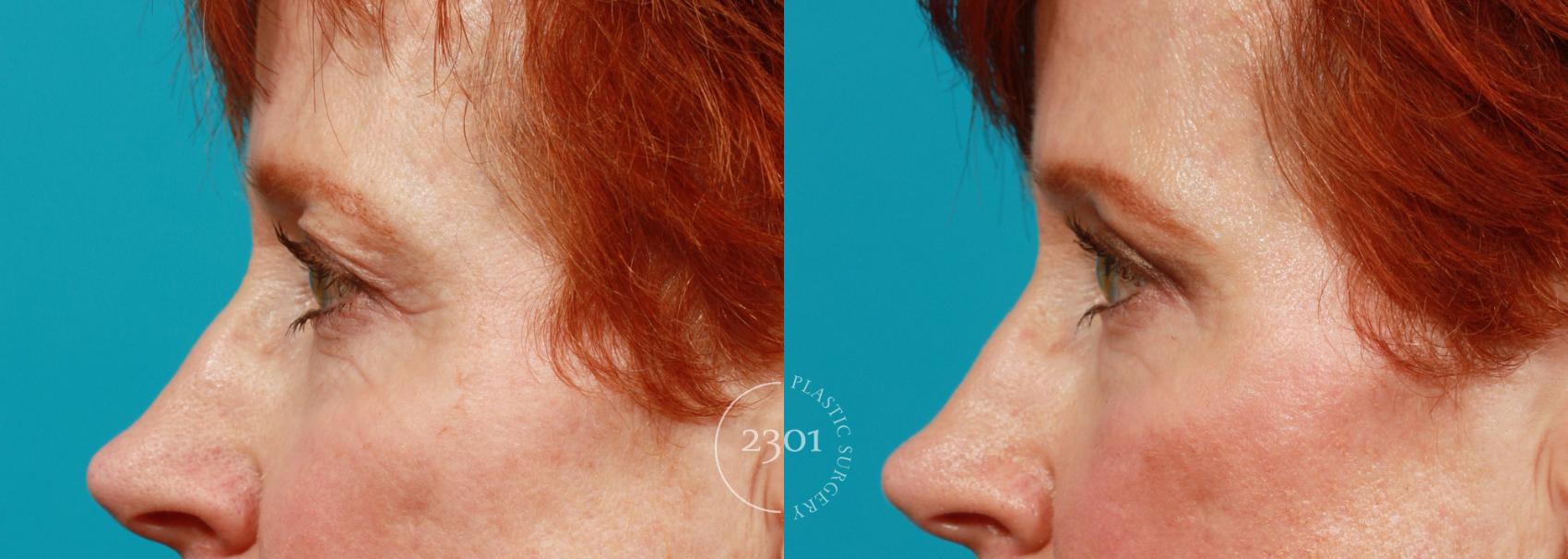 Before & After Blepharoplasty Case 84 View #3 View in Fort Worth, Plano, & Frisco, Texas
