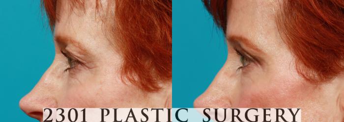 Before & After Blepharoplasty Case 84 View #3 View in Fort Worth, Plano, & Frisco, Texas