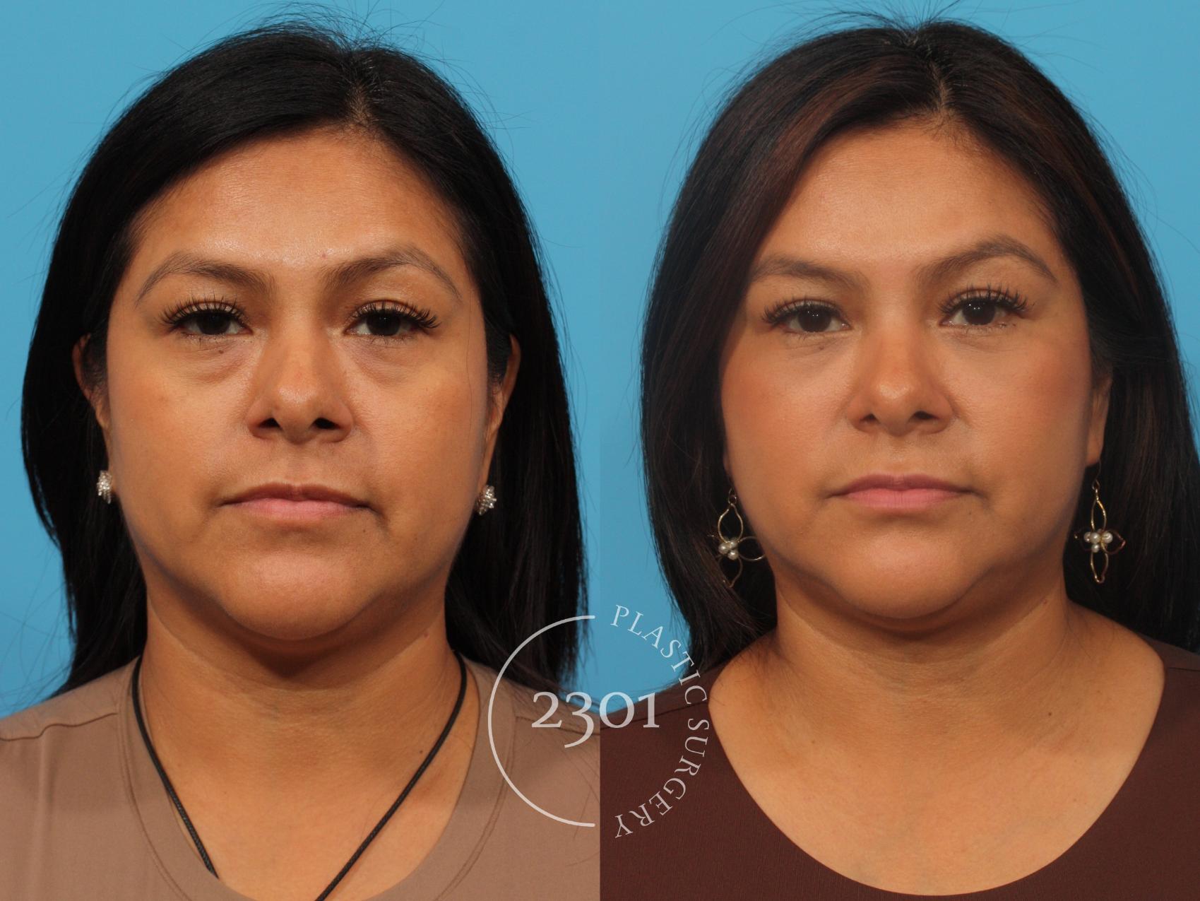 Before & After Blepharoplasty Case 856 Front View in Fort Worth, Plano, & Frisco, Texas