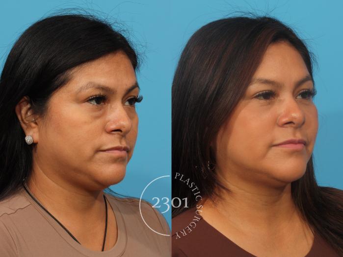 Before & After Blepharoplasty Case 856 Right Oblique View in Fort Worth, Plano, & Frisco, Texas