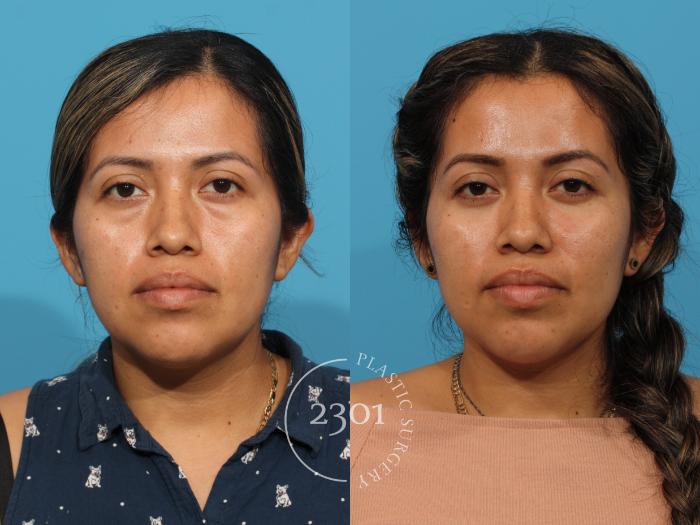 Before & After Facial Fat Grafting Case 857 Front View in Fort Worth, Plano, & Frisco, Texas