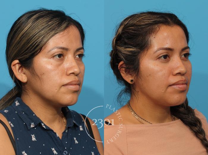 Before & After Facial Fat Grafting Case 857 Right Oblique View in Fort Worth, Plano, & Frisco, Texas