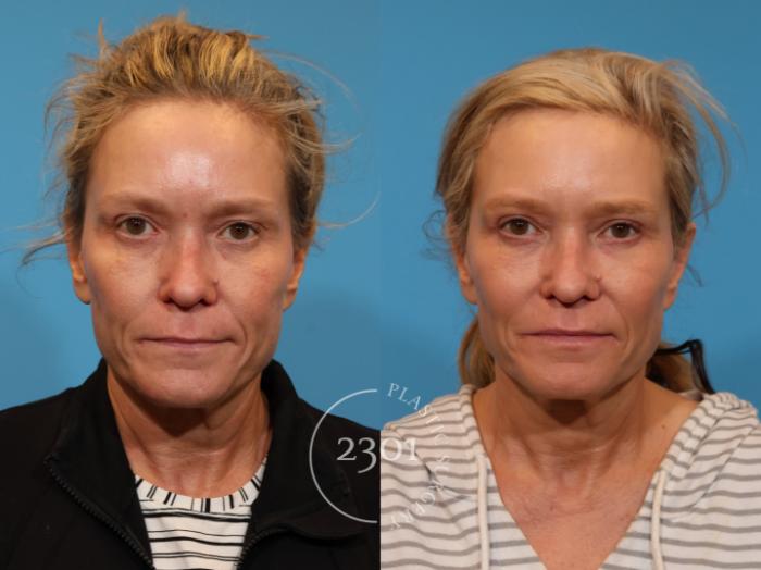 Before & After Blepharoplasty Case 936 Front View in Fort Worth, Plano, & Frisco, Texas